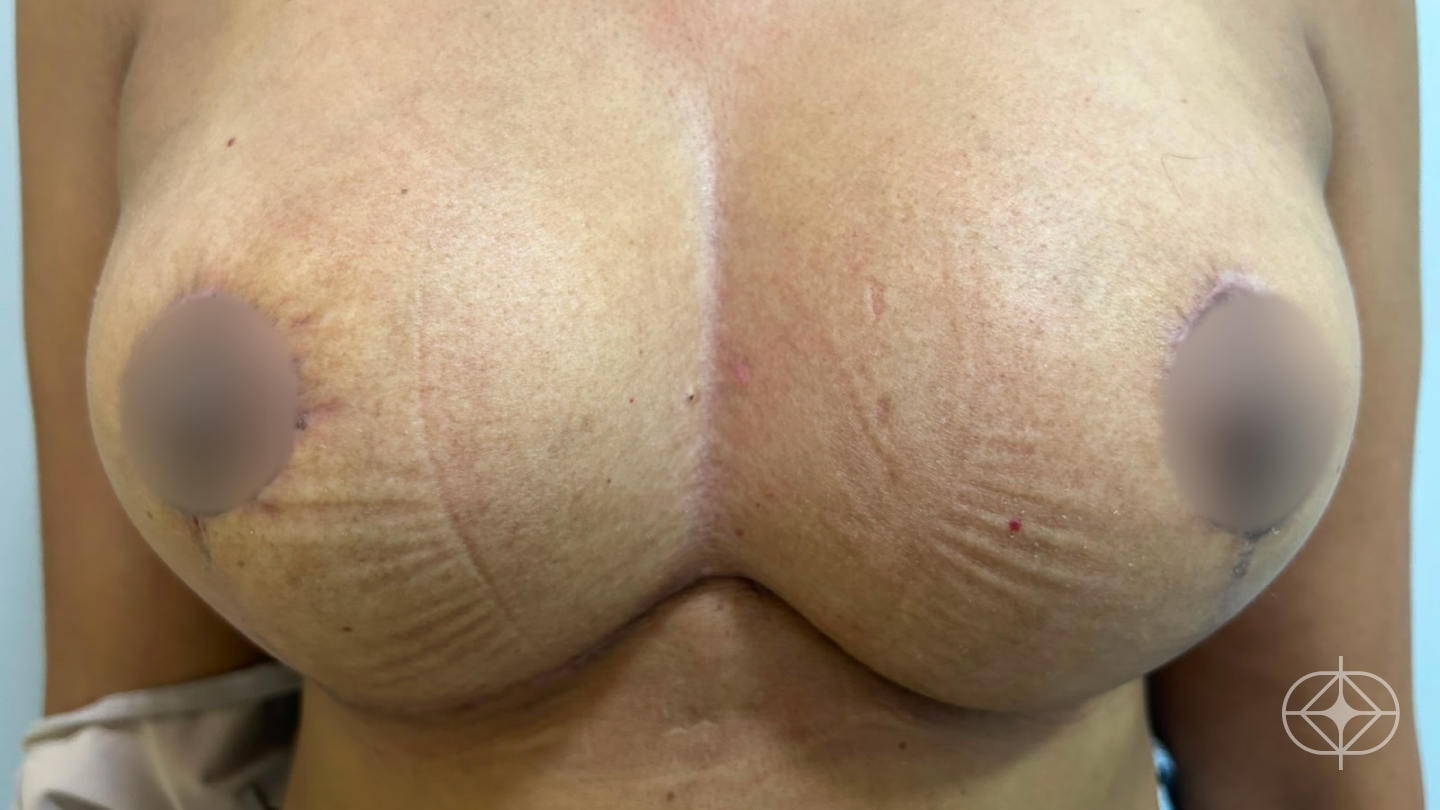 Resultado após Mastopexia com Prótese (silicone) realizado por Dr. Renato Saliba Donatelli