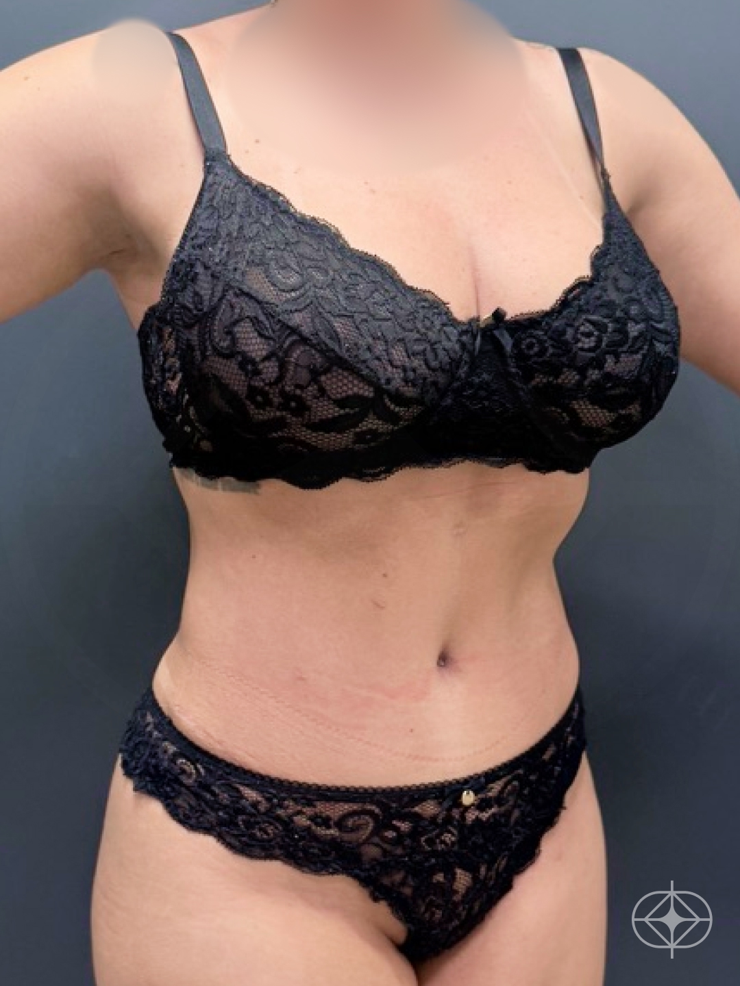 Resultado após Abdominoplastia realizado por Dr. Felipe de David