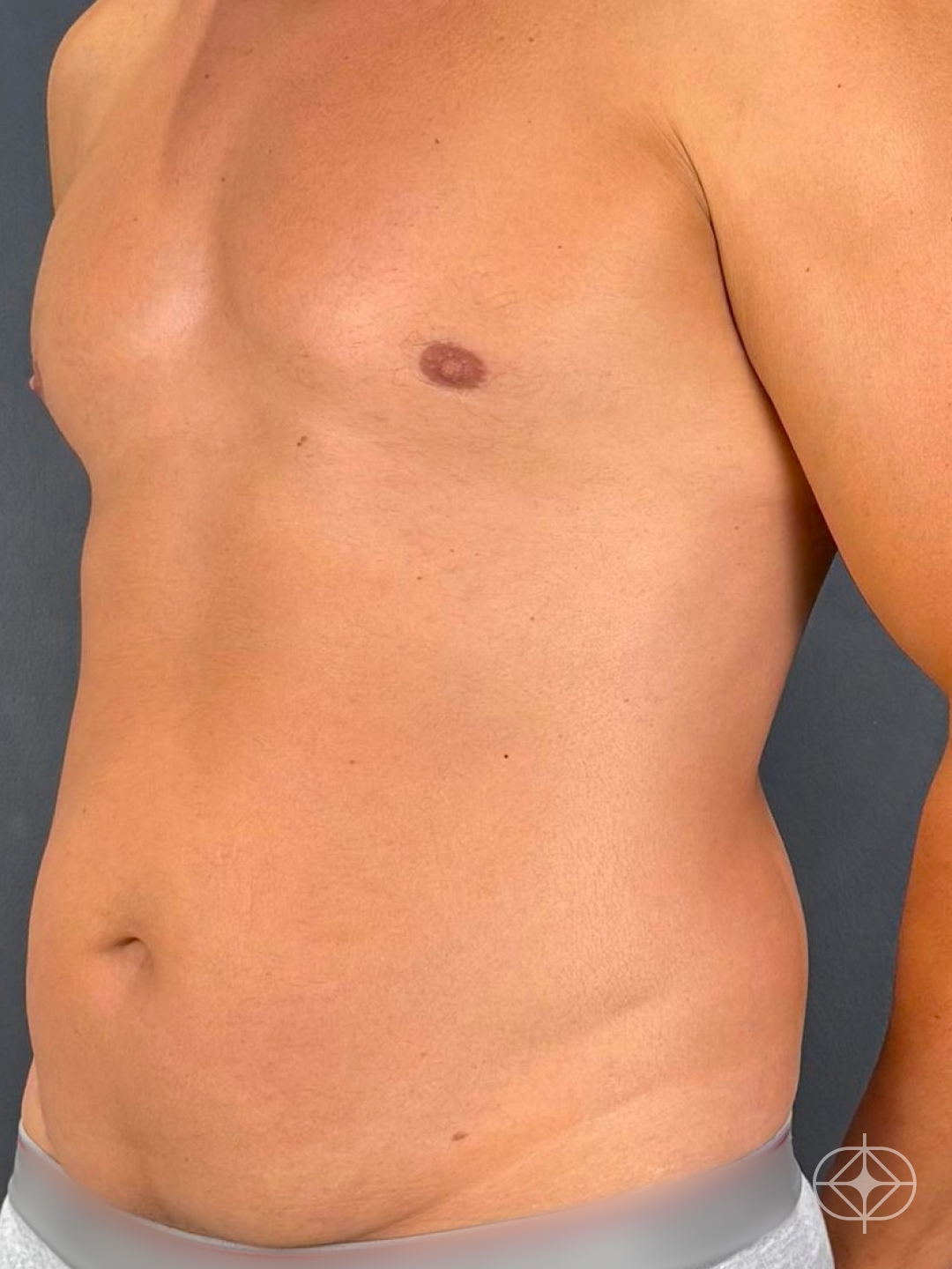 Foto antes de Lipoaspiração / Lipo HD realizado por Dr. Luis Fernando Bacarin