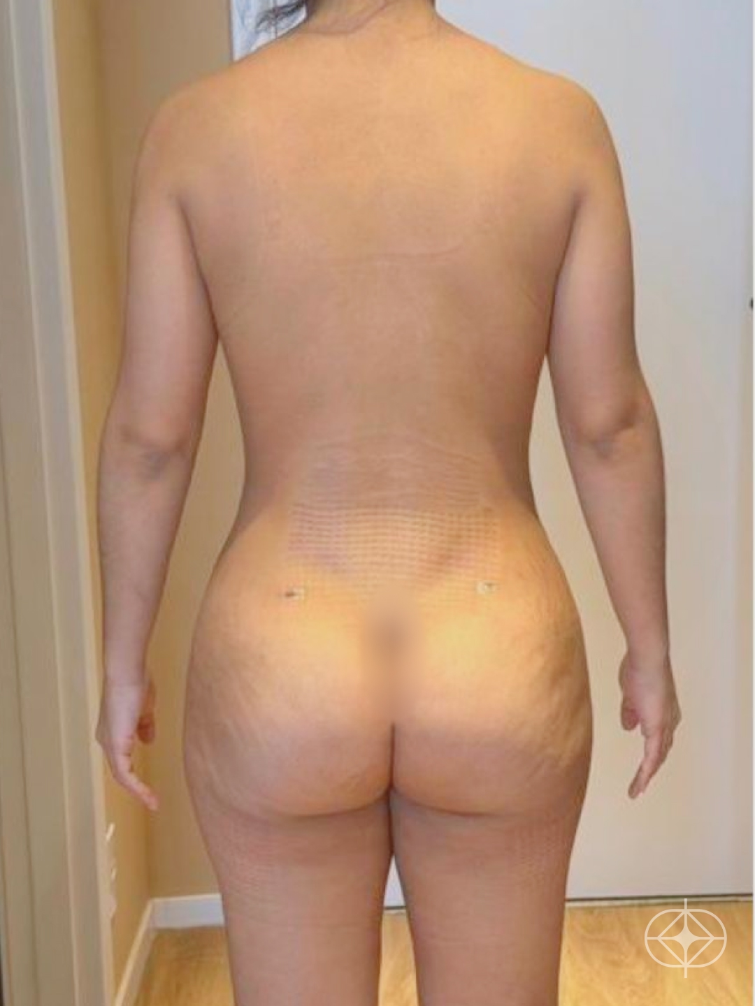 Resultado após Lipoaspiração / Lipo HD realizado por Dr. João Ferreira