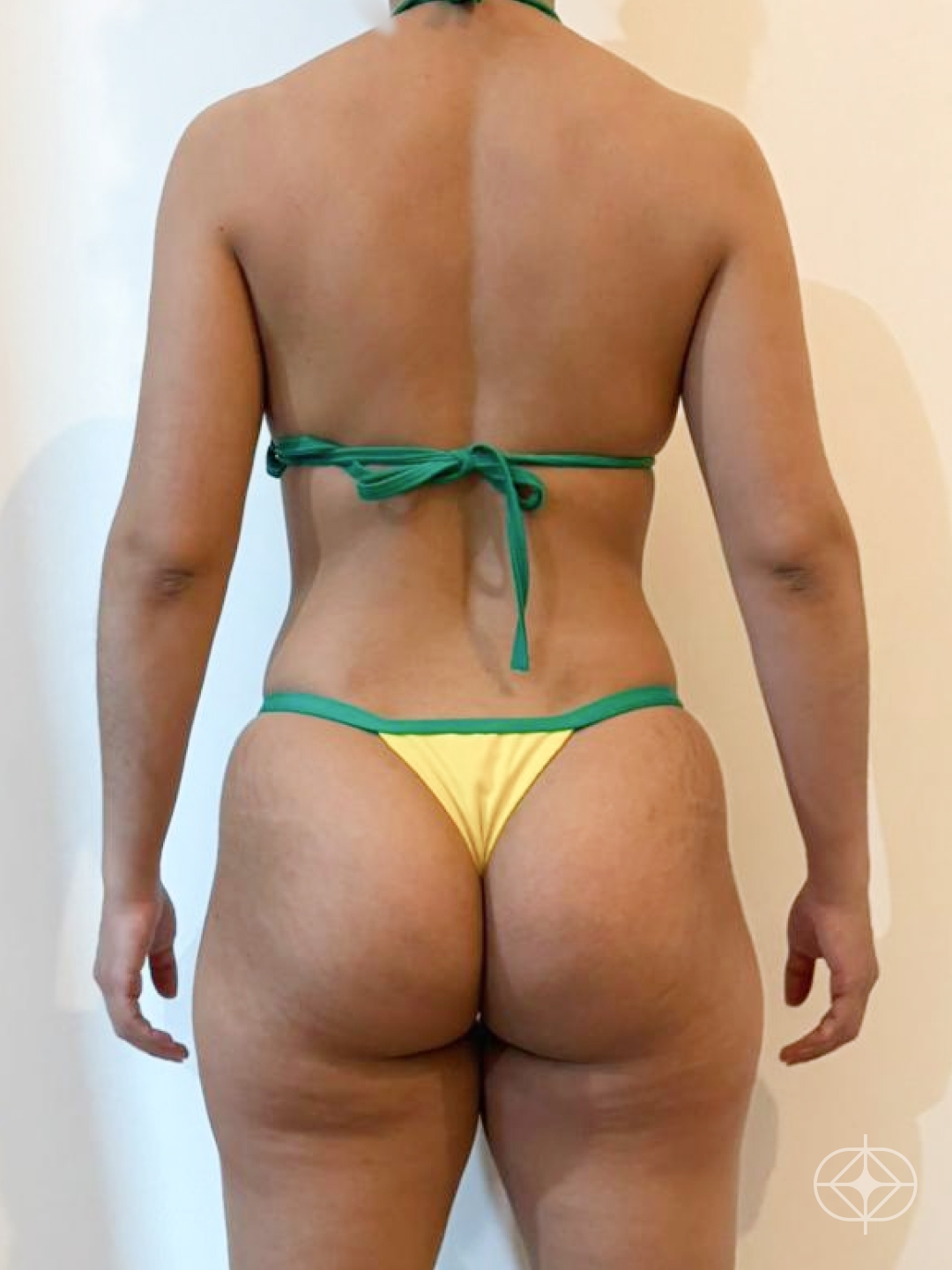 Foto antes de Lipoaspiração / Lipo HD realizado por Dr. João Ferreira