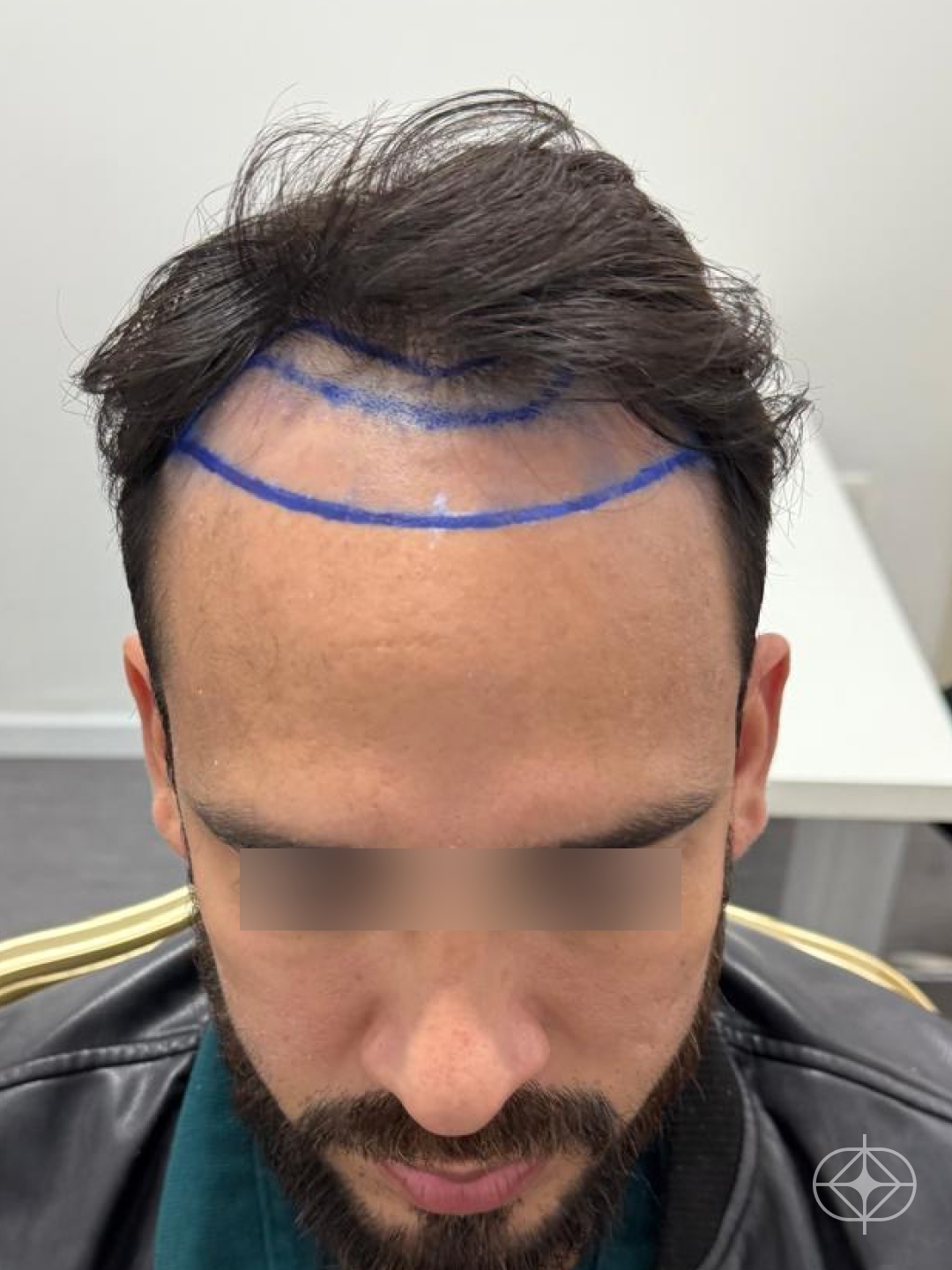 Foto antes de Transplante Capilar (cabelo) realizado por Dr. Mohamed Najmeddine