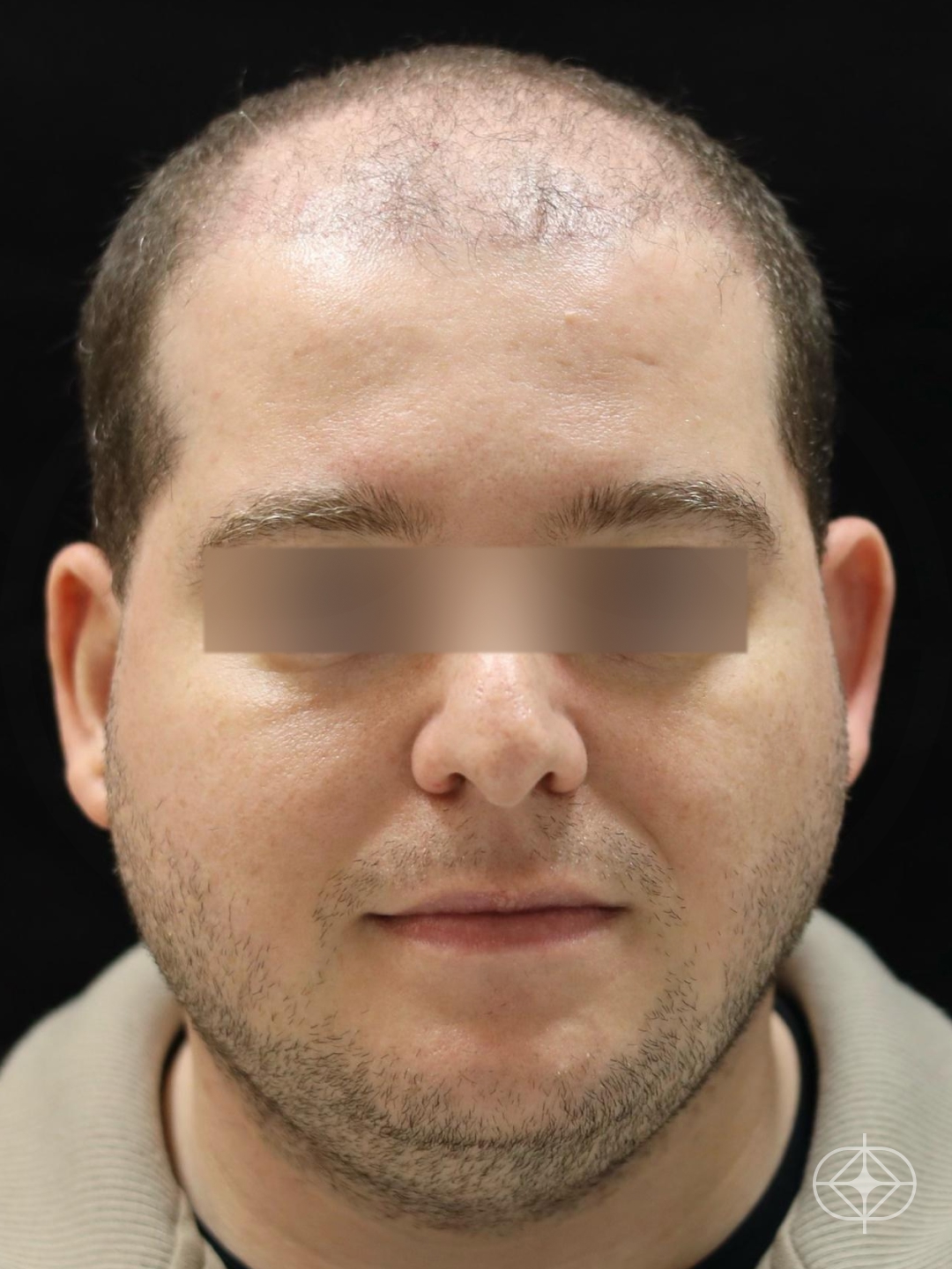 Foto antes de Otoplastia (orelhas) realizado por Dr. Eduardo Zomer