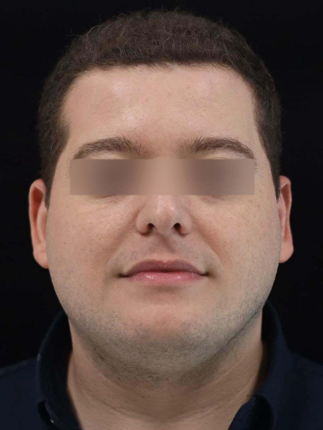 Resultado após Otoplastia (orelhas) realizado por Dr. Eduardo Zomer