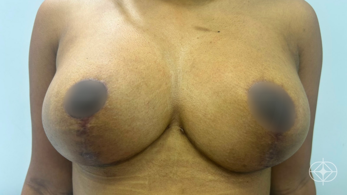 Resultado após Mamoplastia Redutora realizado por Dr. Renato Saliba Donatelli