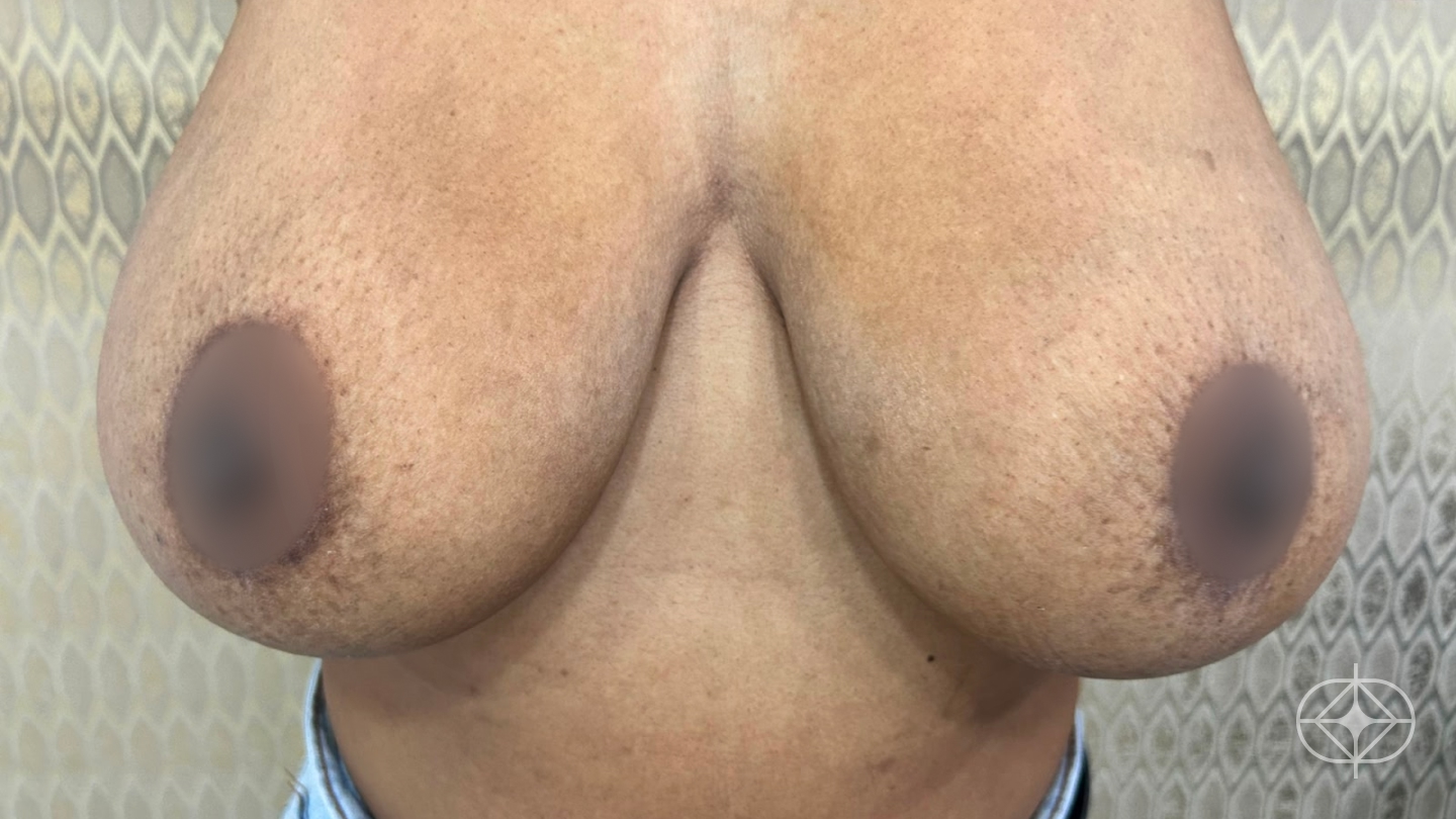 Foto antes de Mamoplastia Redutora realizado por Dr. Renato Saliba Donatelli