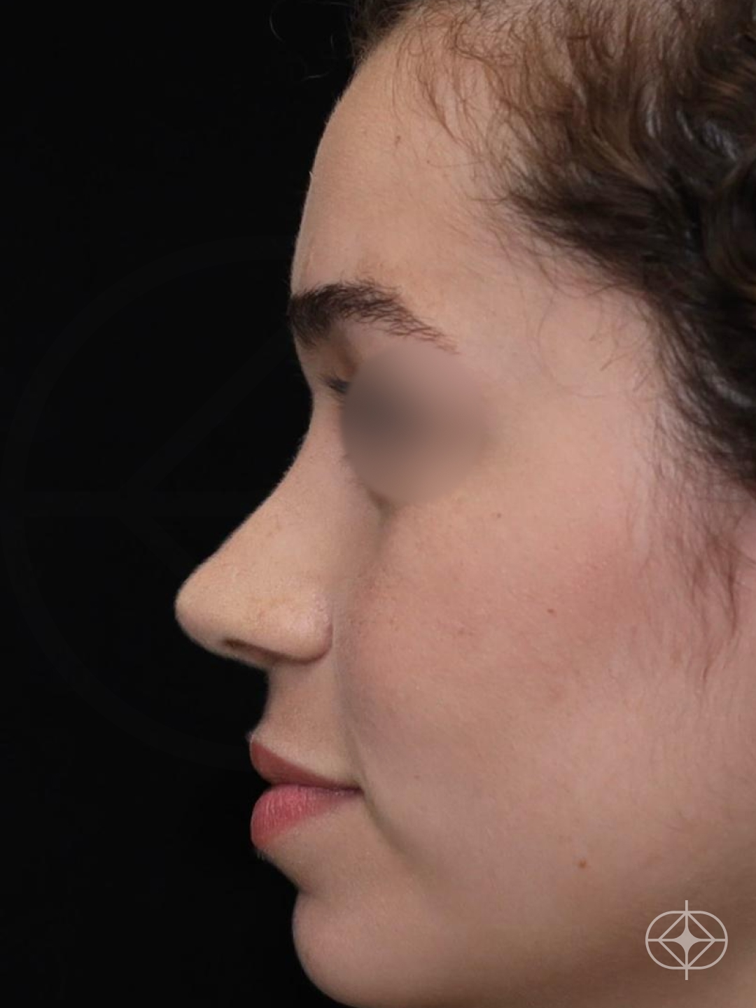 Resultado após Rinoplastia (nariz) realizado por Dr. Eduardo Zomer