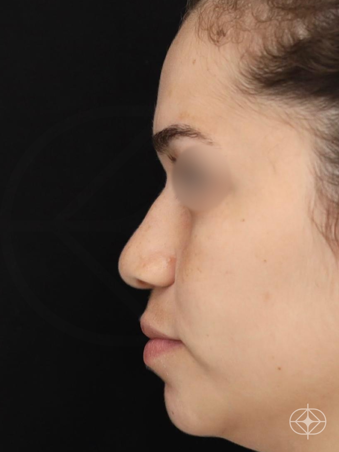 Foto antes de Rinoplastia (nariz) realizado por Dr. Eduardo Zomer