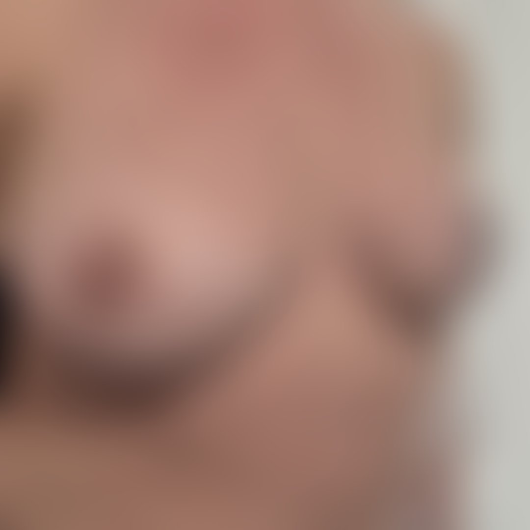 Foto antes de Reconstrução Mamária (mastectomia) realizado por Dr. Adriano Oliveira