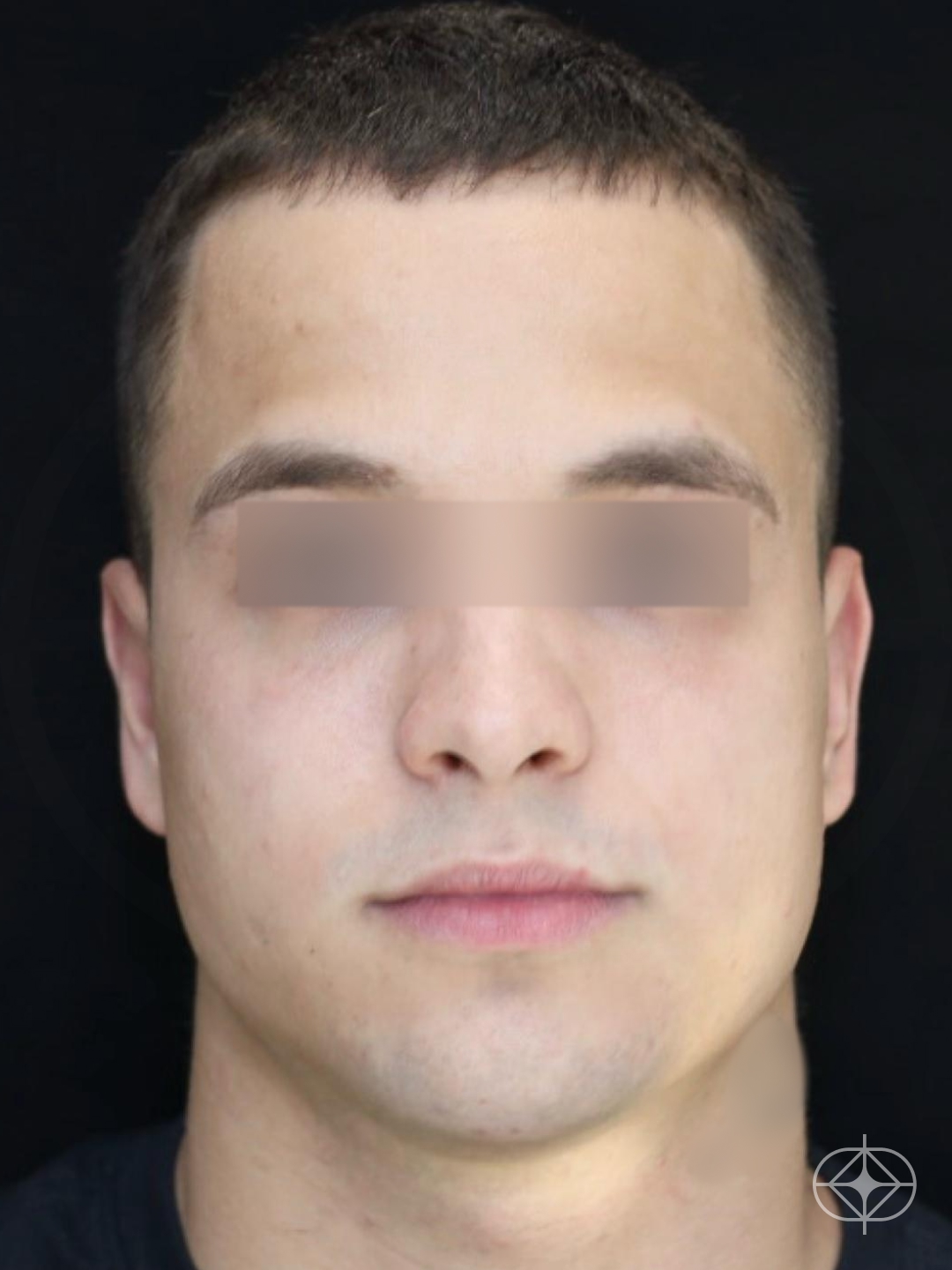 Resultado após Otoplastia (orelhas) realizado por Dr. Eduardo Zomer
