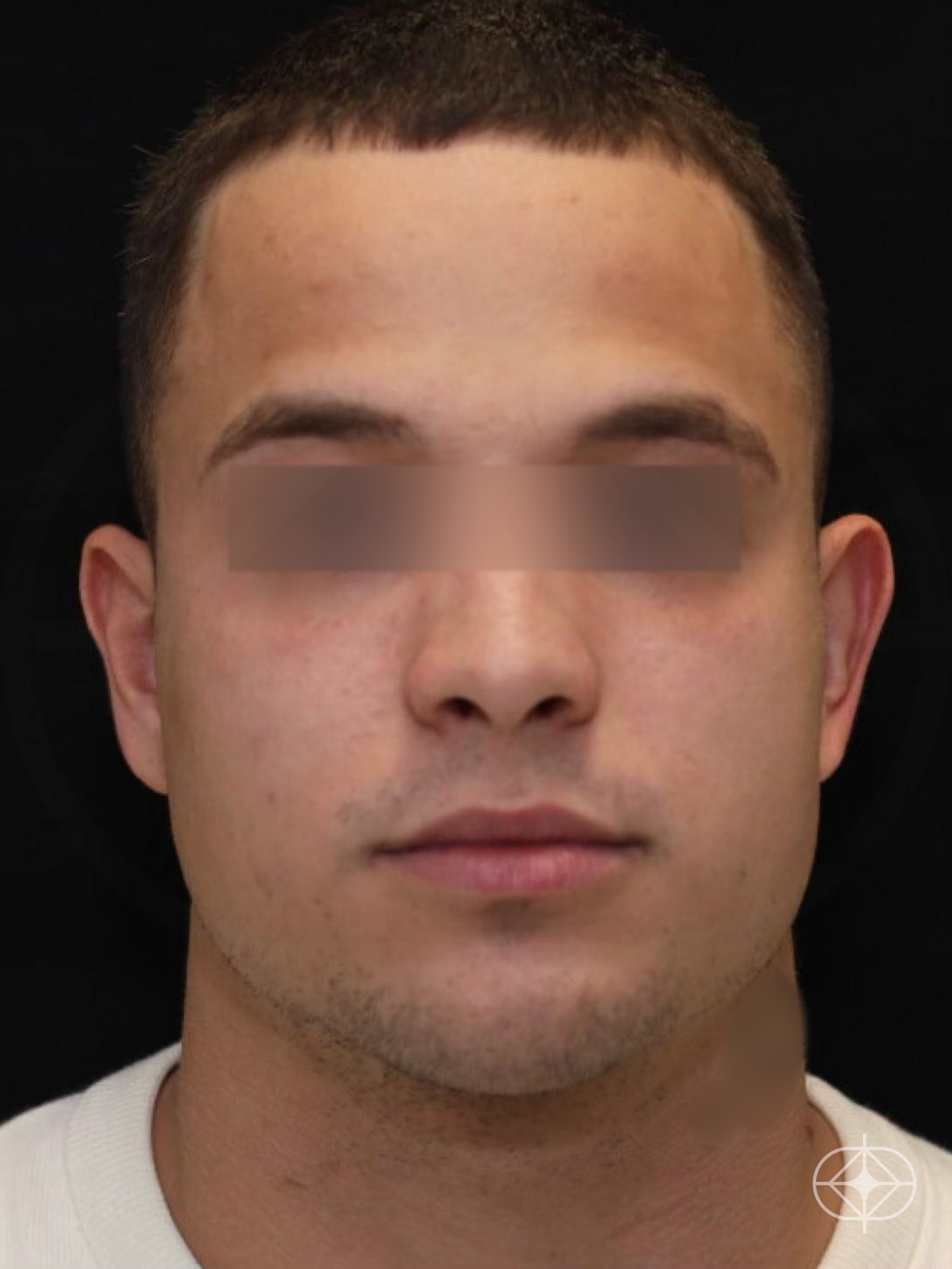 Foto antes de Otoplastia (orelhas) realizado por Dr. Eduardo Zomer