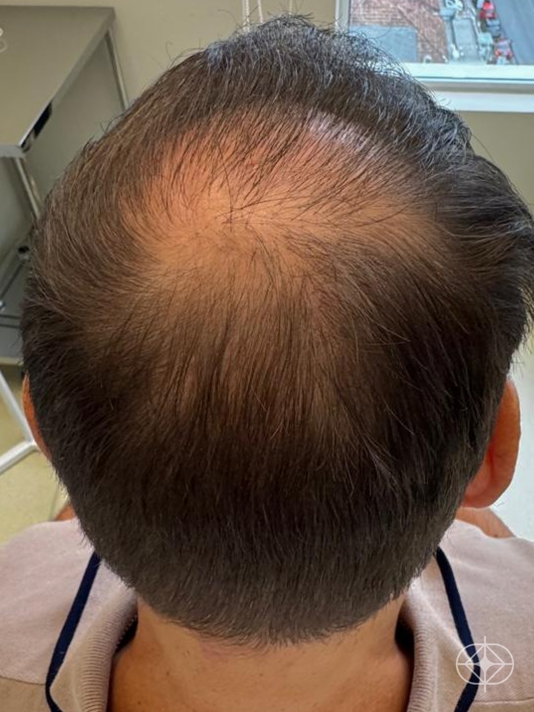 Resultado após Transplante Capilar (cabelo) realizado por Dra. Fernanda Vicente