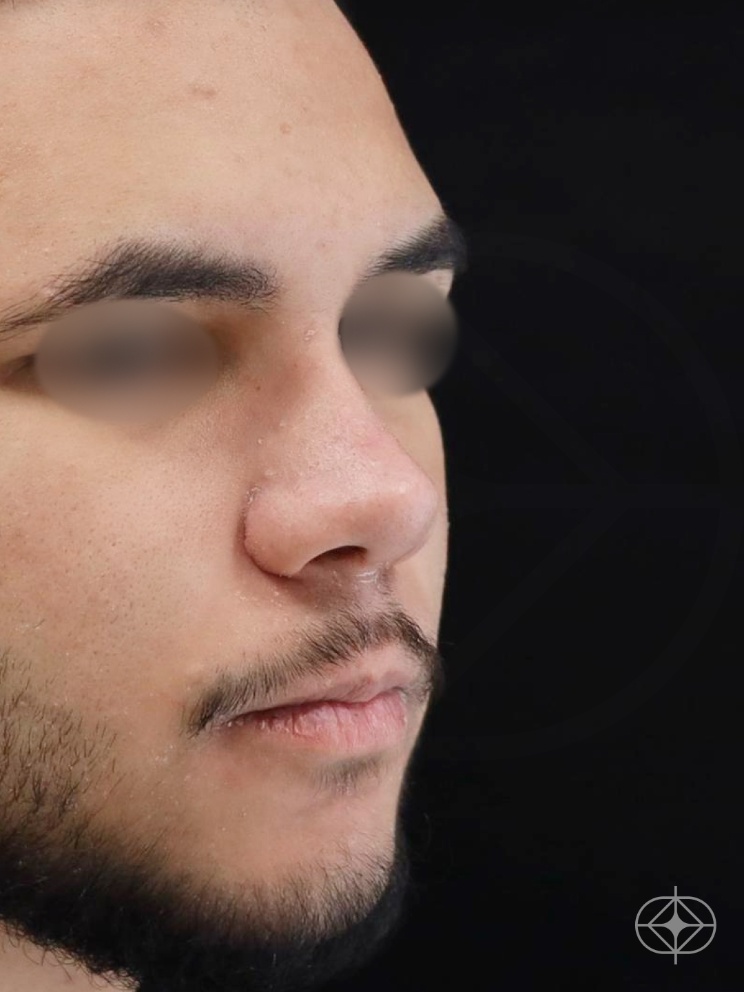 Resultado após Rinoplastia (nariz) realizado por Dr. Eduardo Zomer