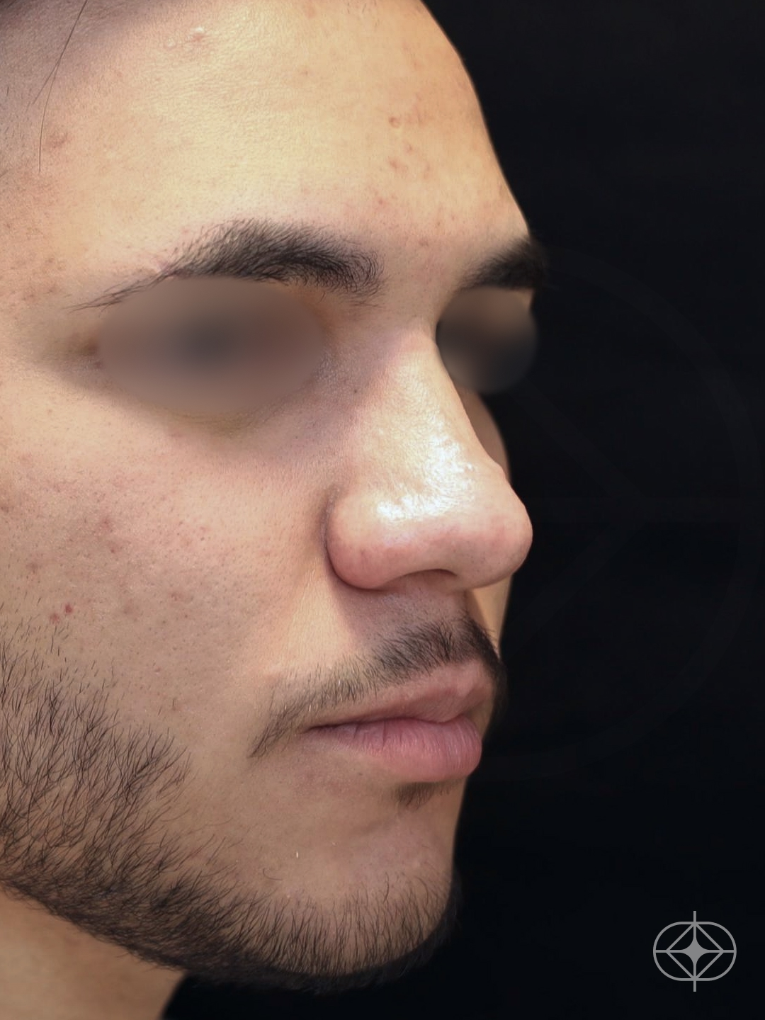 Foto antes de Rinoplastia (nariz) realizado por Dr. Eduardo Zomer