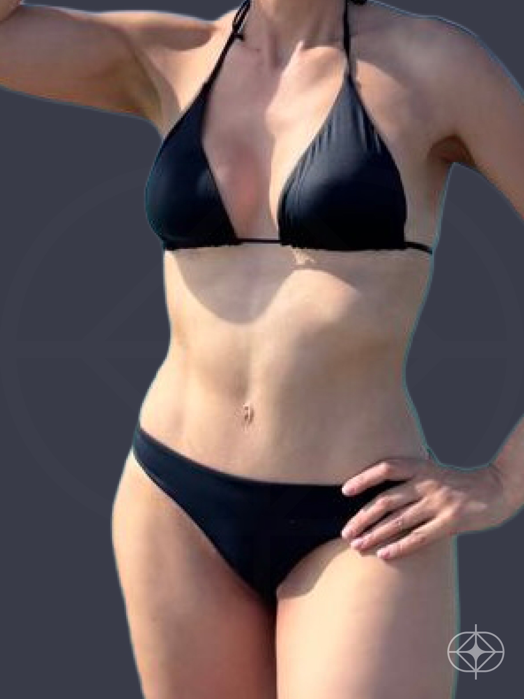 Resultado após Lipoaspiração / Lipo HD realizado por Dr. Luis Fernando Bacarin