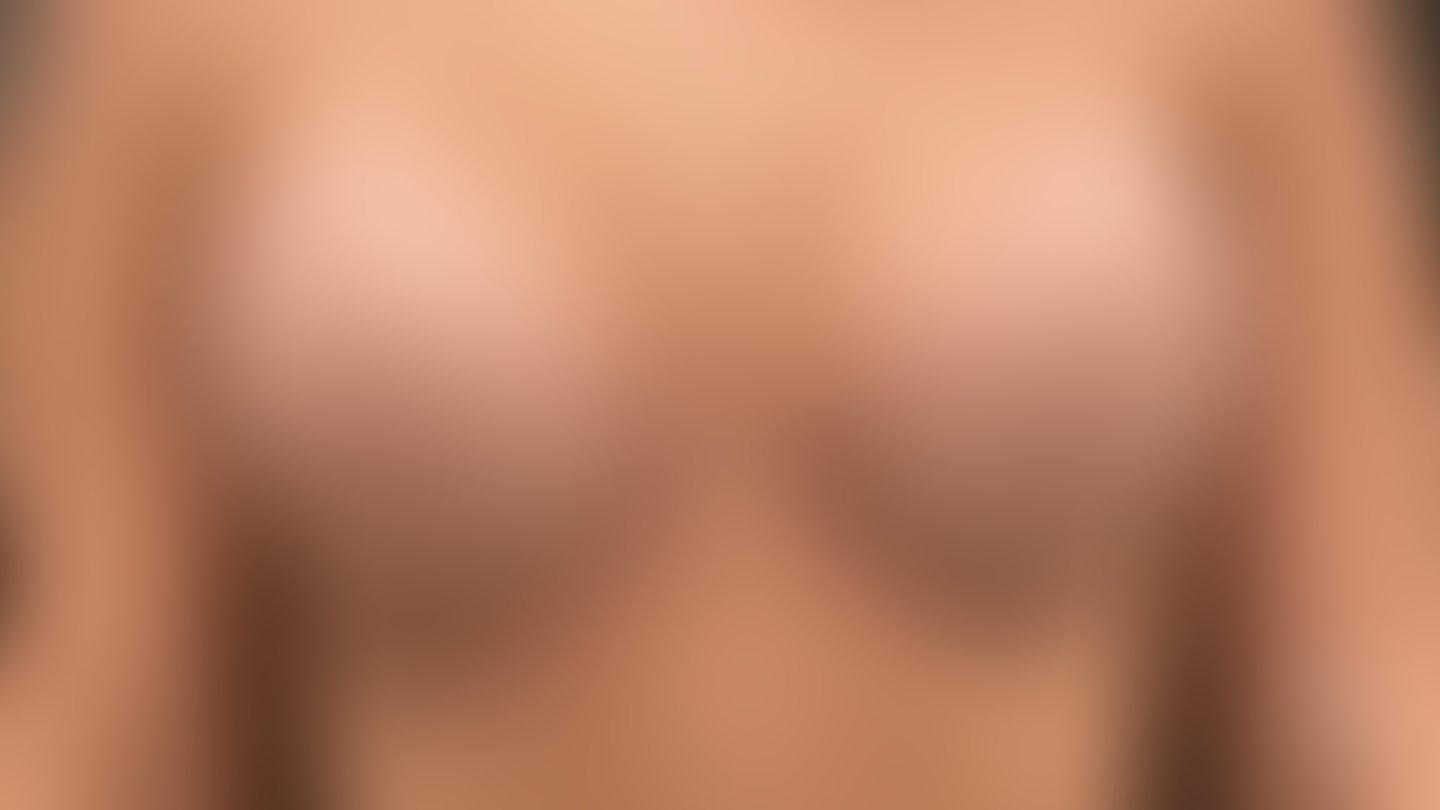 Resultado após Preservé Prótese de Mama (silicone) realizado por Dr. Eduardo Fraga
