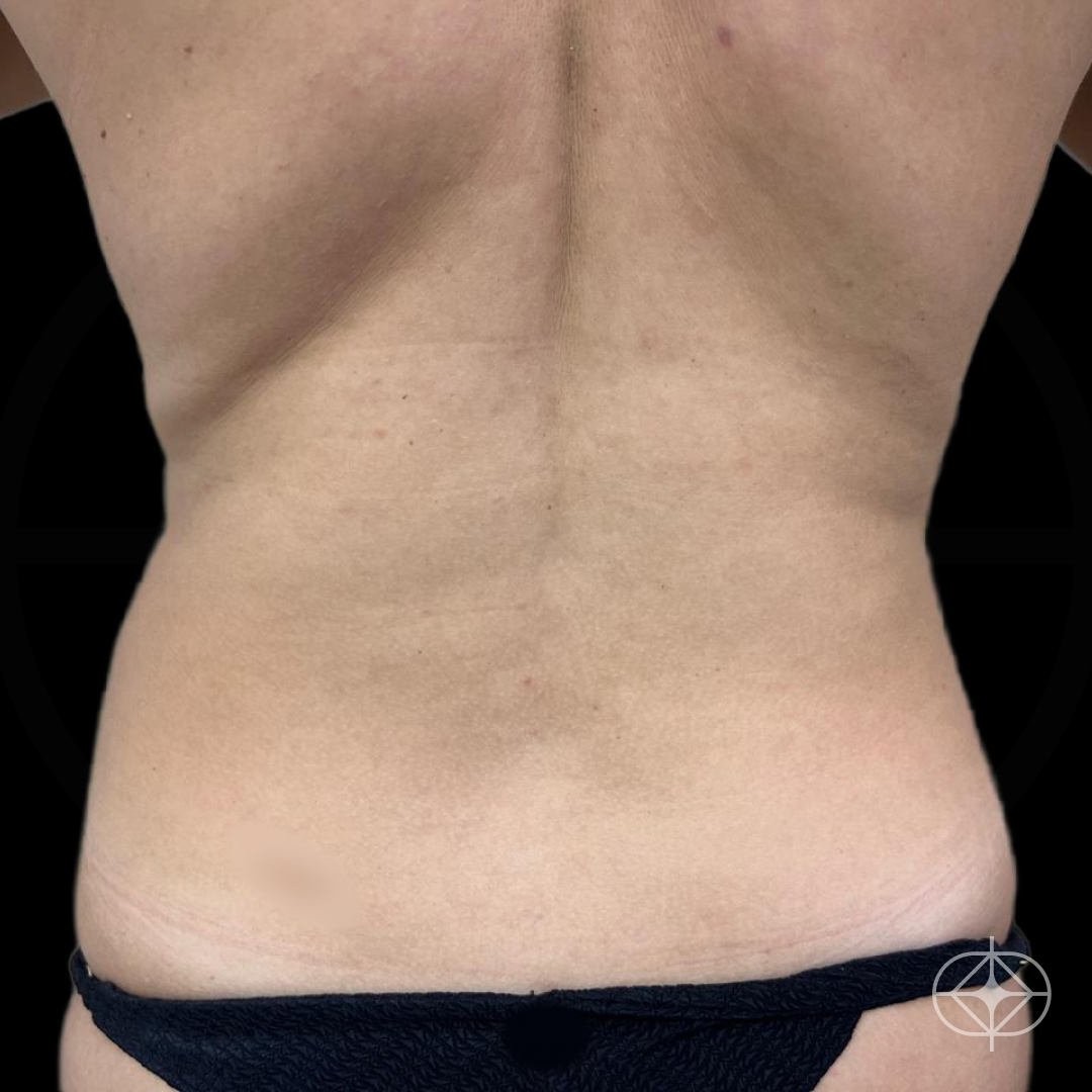 Foto antes de Lipoaspiração / Lipo HD realizado por Dr. Renato Saliba Donatelli