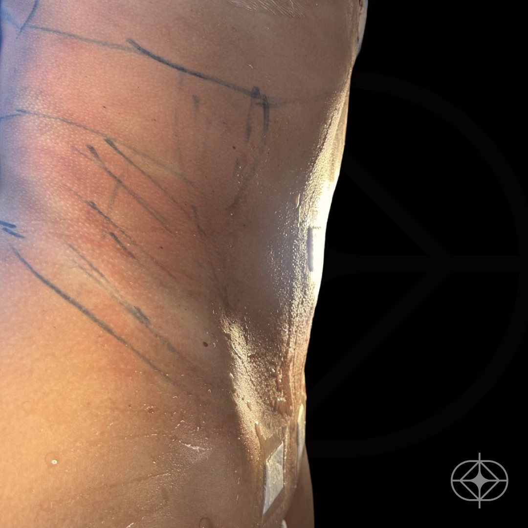 Resultado após Lipoaspiração / Lipo HD realizado por Dr. Renato Saliba Donatelli