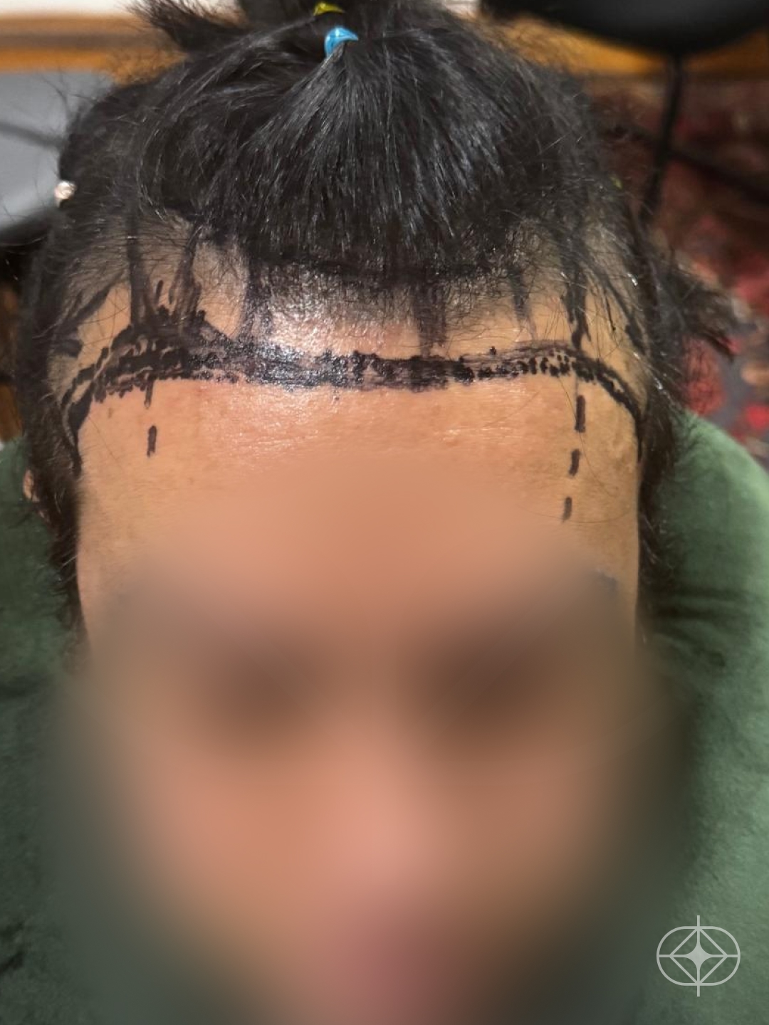 Foto antes de Transplante Capilar (cabelo) realizado por Dra. Fernanda Vicente