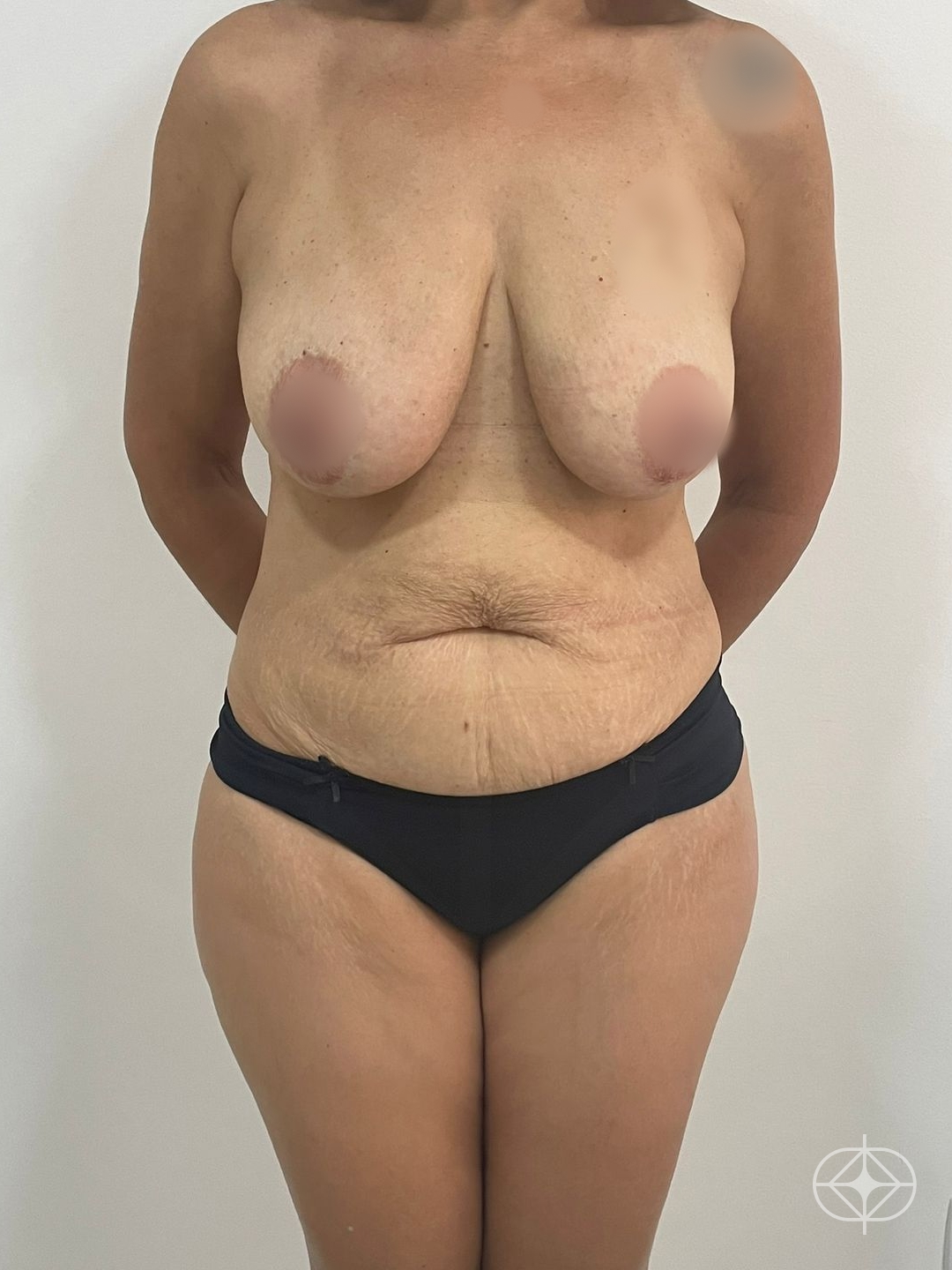 Foto antes de Abdominoplastia realizado por Dr. João Ferreira