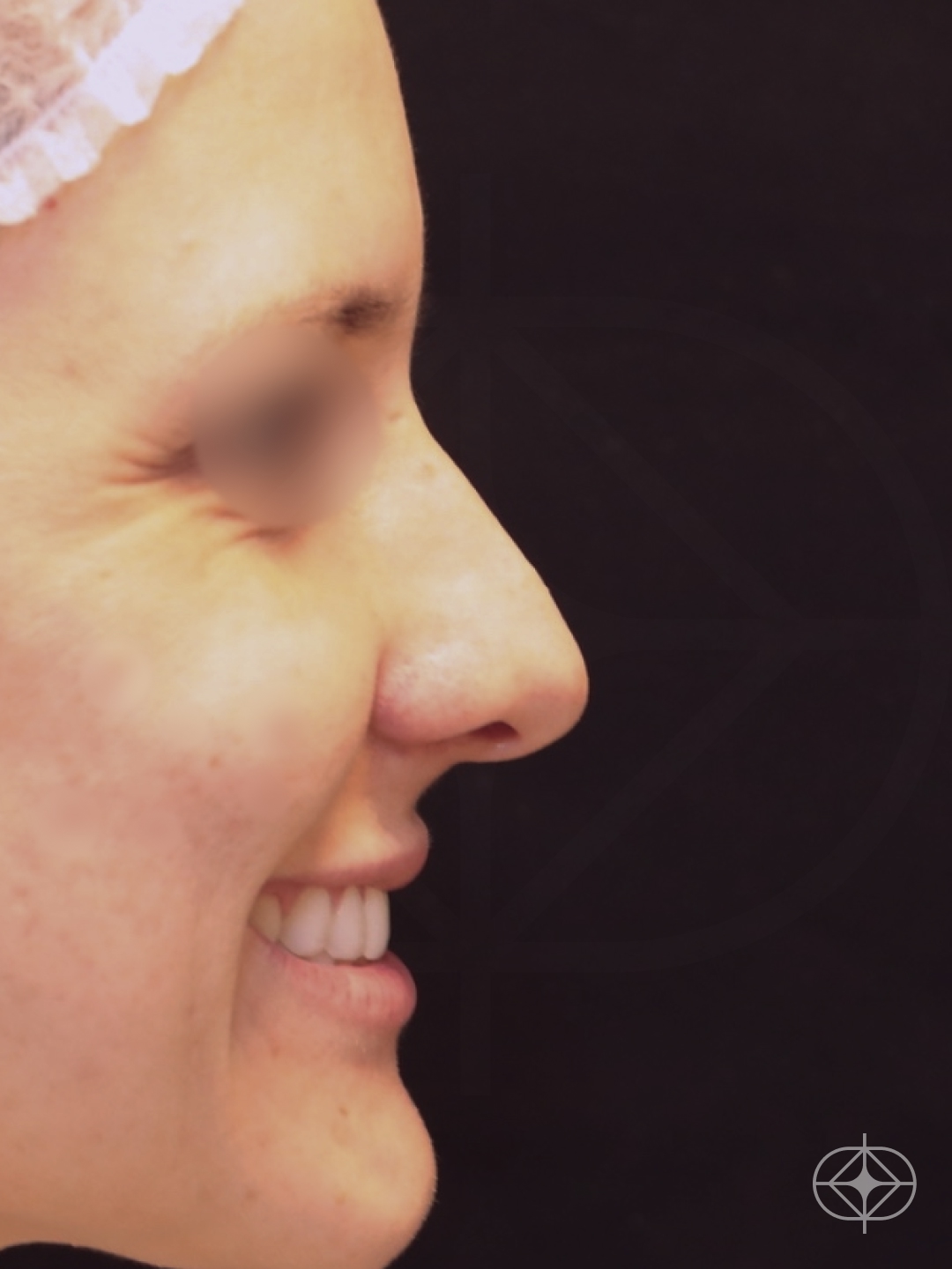 Foto antes de Rinoplastia (nariz) realizado por Dr. Eduardo Zomer