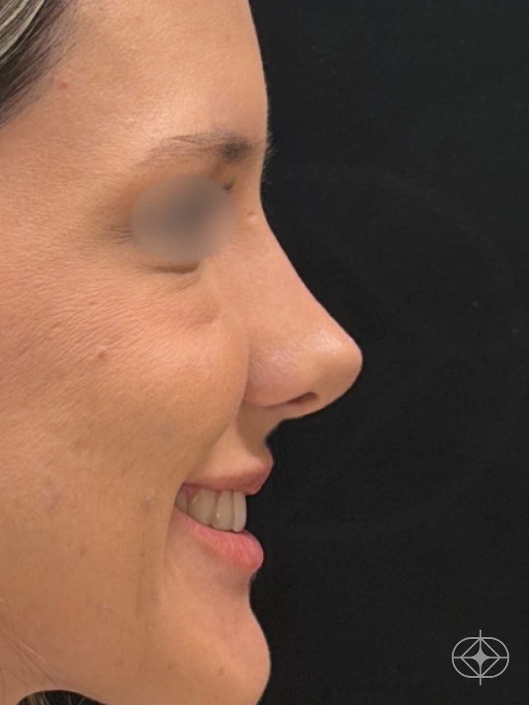 Resultado após Rinoplastia (nariz) realizado por Dr. Eduardo Zomer