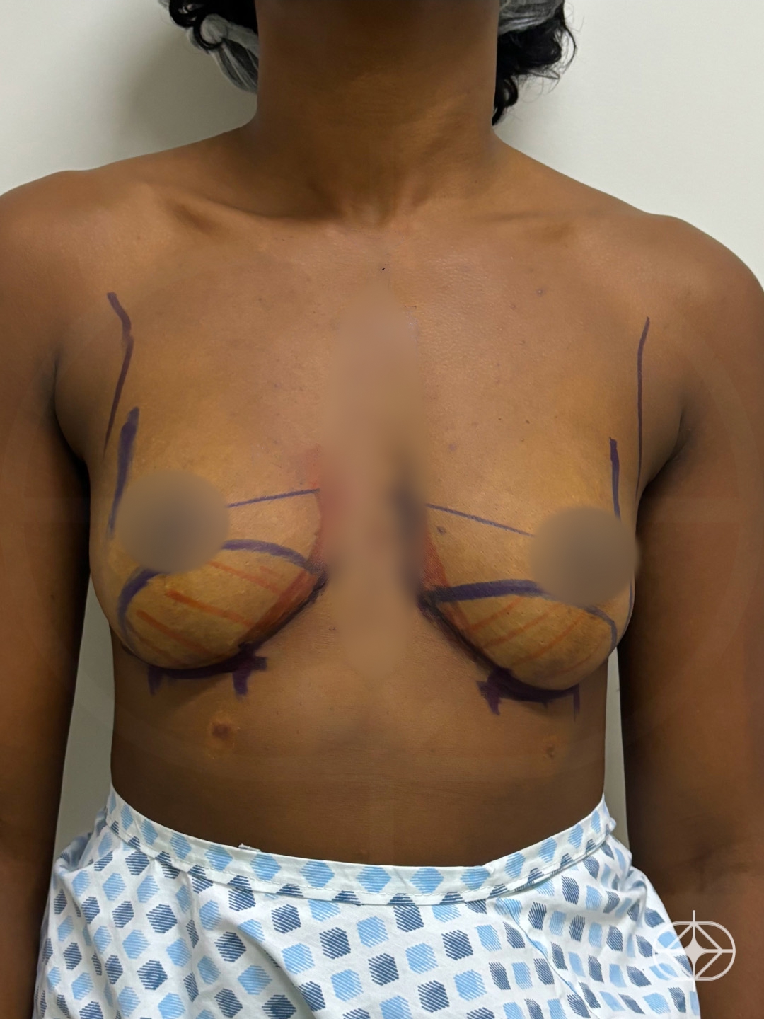 Foto antes de Prótese Mama / R24R (silicone) realizado por Dr. Mateus Neves