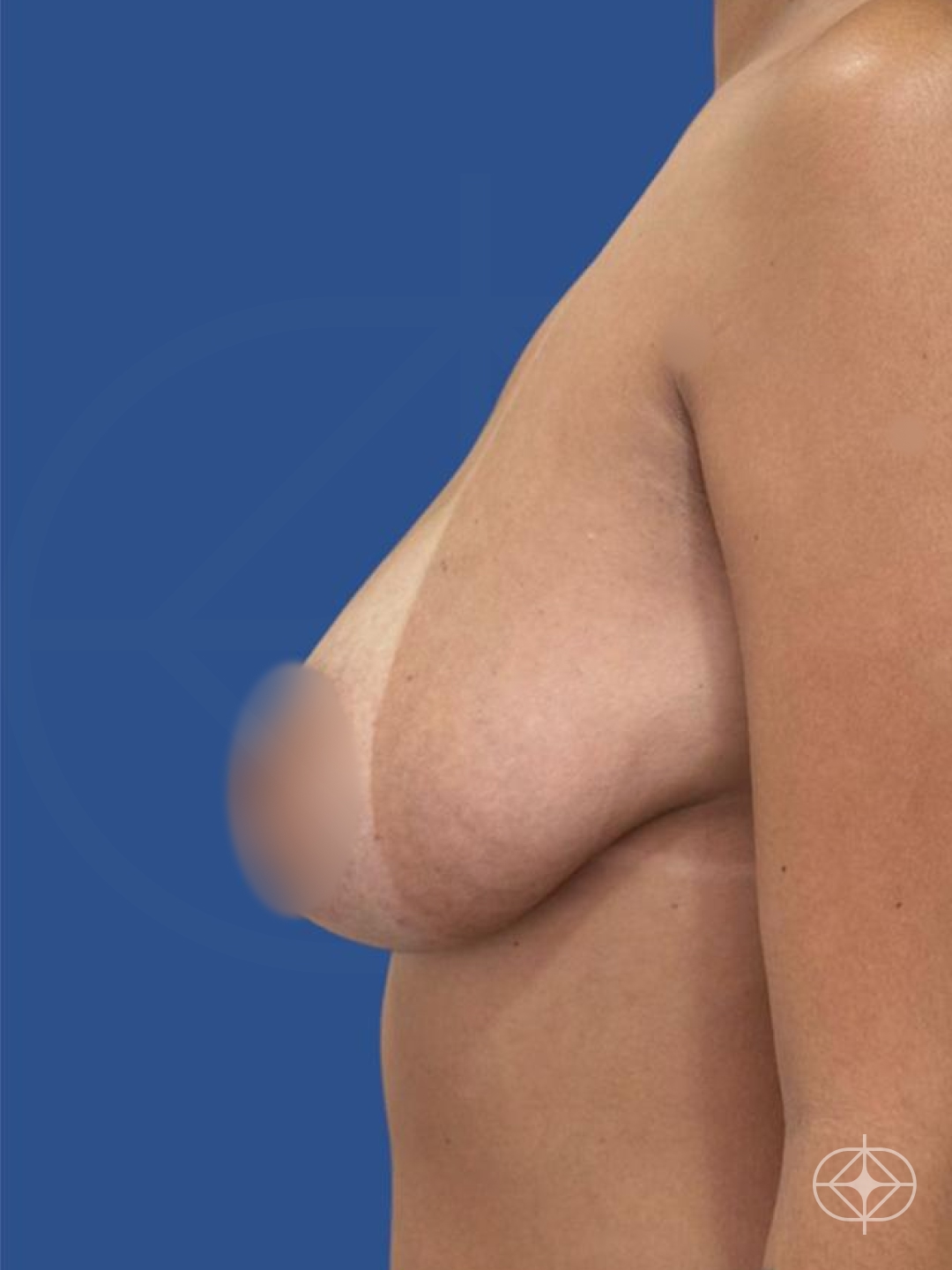 Foto antes de Mamoplastia Redutora realizado por Dr. Manoel Bizerra