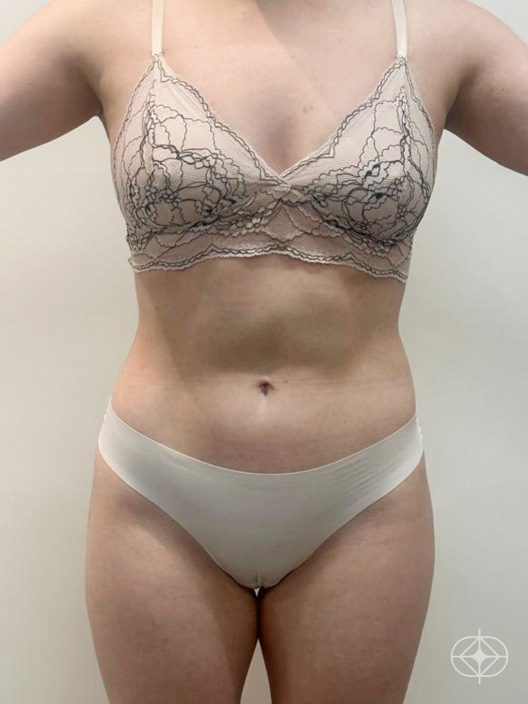 Lipoaspiração / Lipo HD - Pós