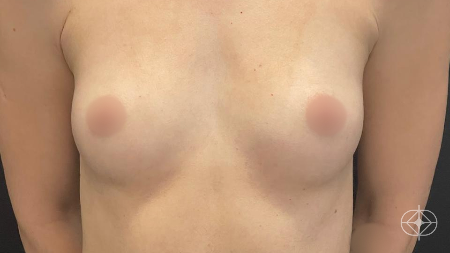 Foto antes de Preservé Prótese de Mama (silicone) realizado por Dr. Eduardo Fraga