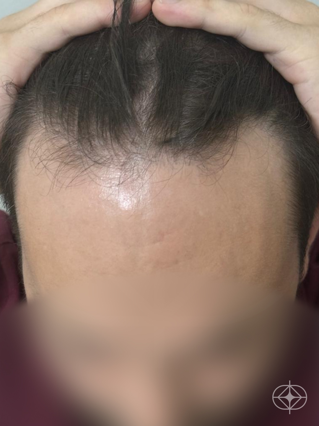 Foto antes de Transplante Capilar (cabelo) realizado por Dra. Fernanda Vicente