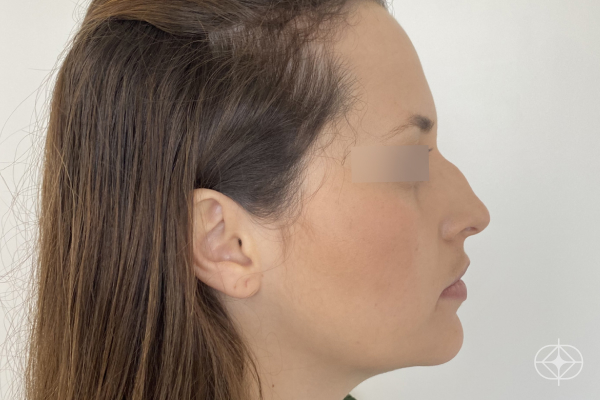 Rinoplastia - Pré