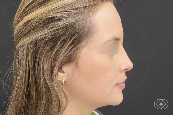 Rinoplastia - Pós
