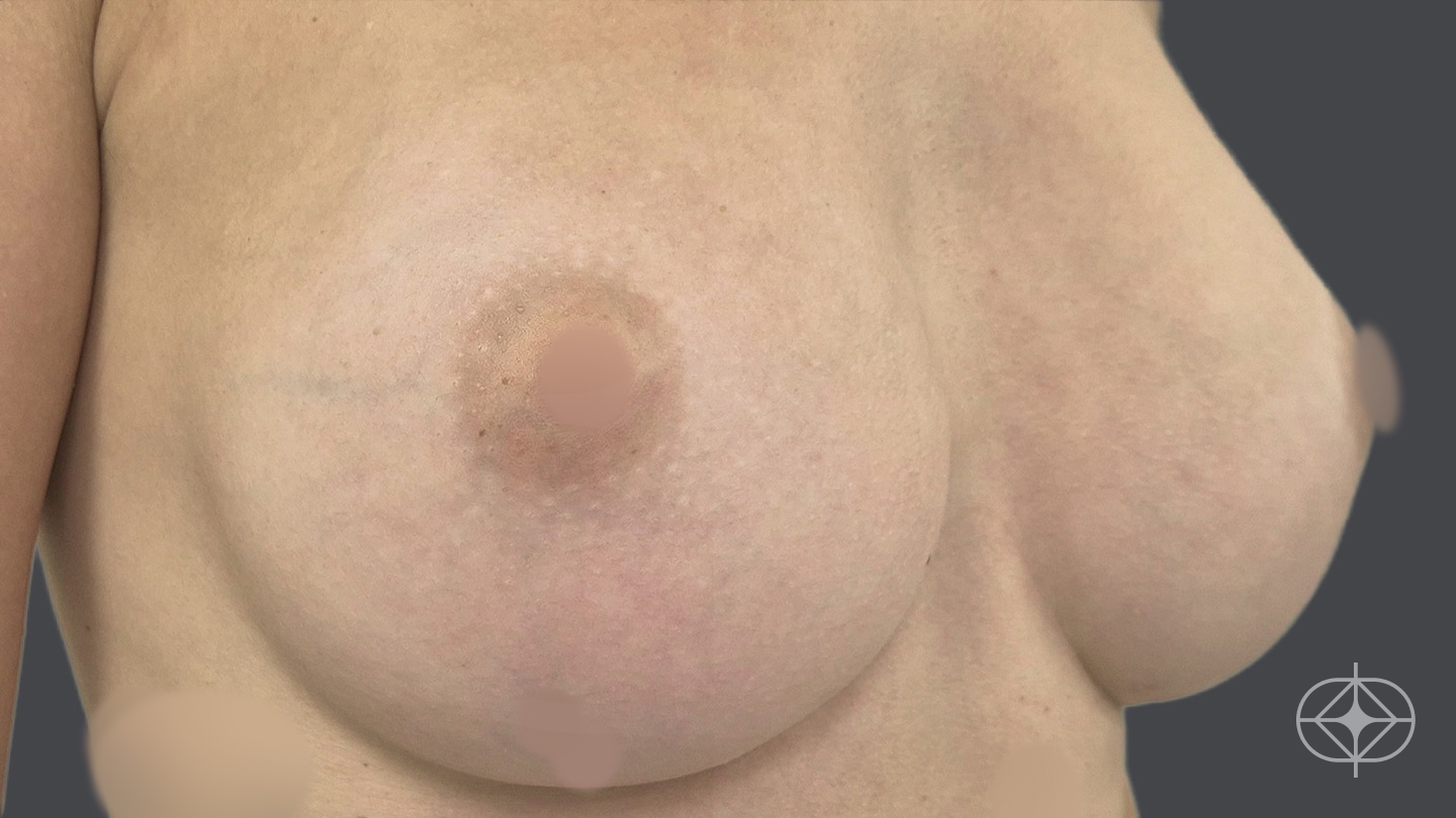 Foto antes de Reconstrução Mamária (mastectomia) realizado por Dr. Adriano Oliveira