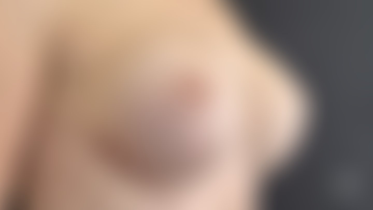 Resultado após Reconstrução Mamária (mastectomia) realizado por Dr. Adriano Oliveira