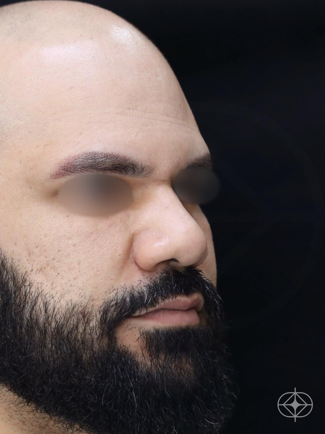 Foto antes de Rinoplastia (nariz) realizado por Dr. Eduardo Zomer