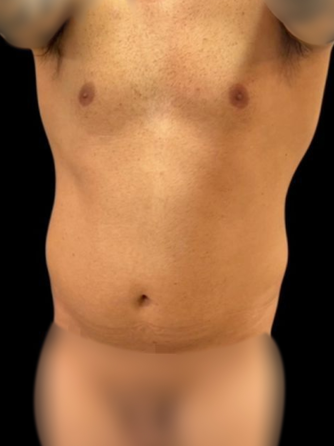 Foto antes de Lipoaspiração / Lipo HD realizado por Dr. Edgar Lopez Campos
