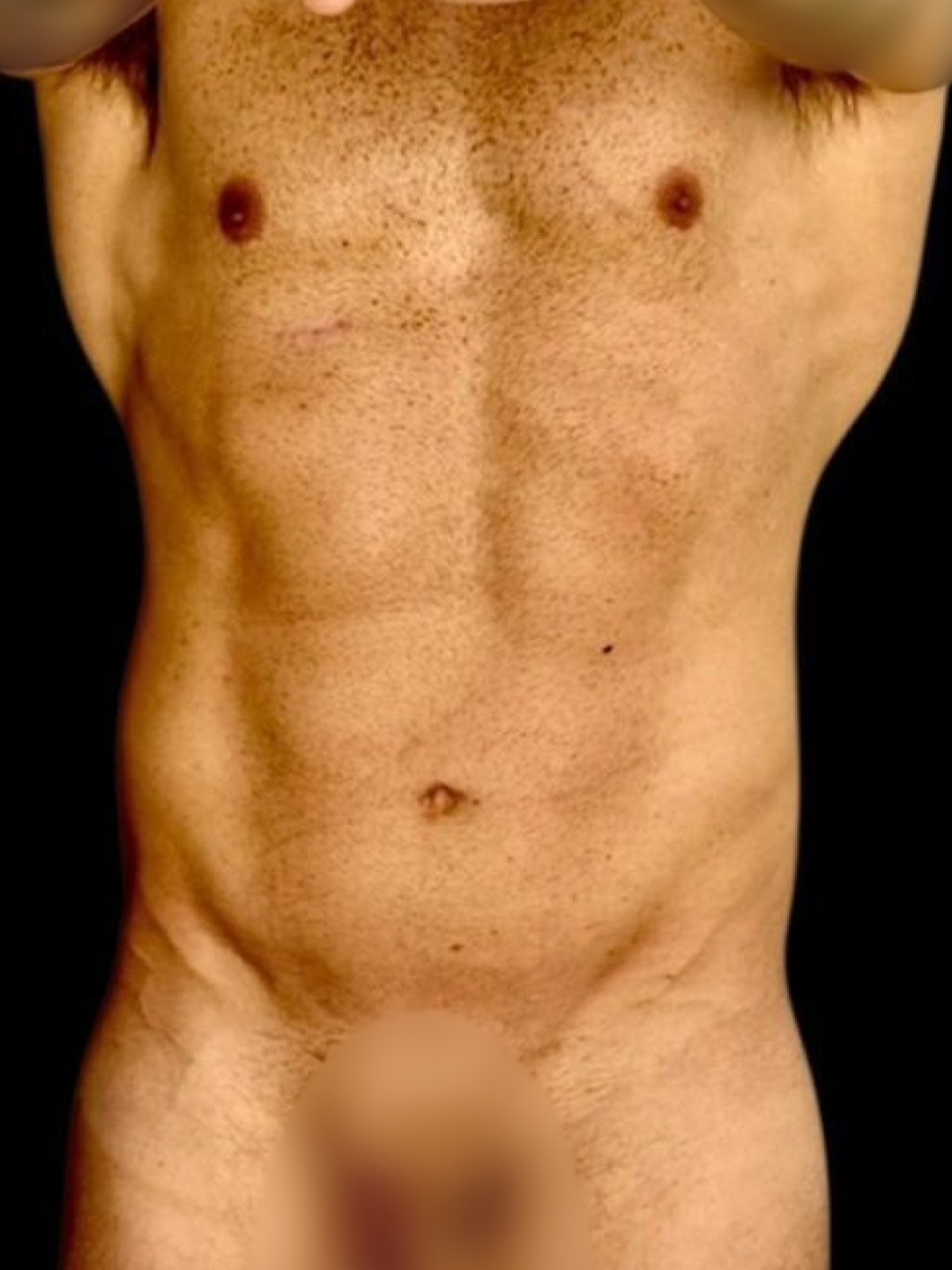 Resultado após Lipoaspiração / Lipo HD realizado por Dr. Edgar Lopez Campos