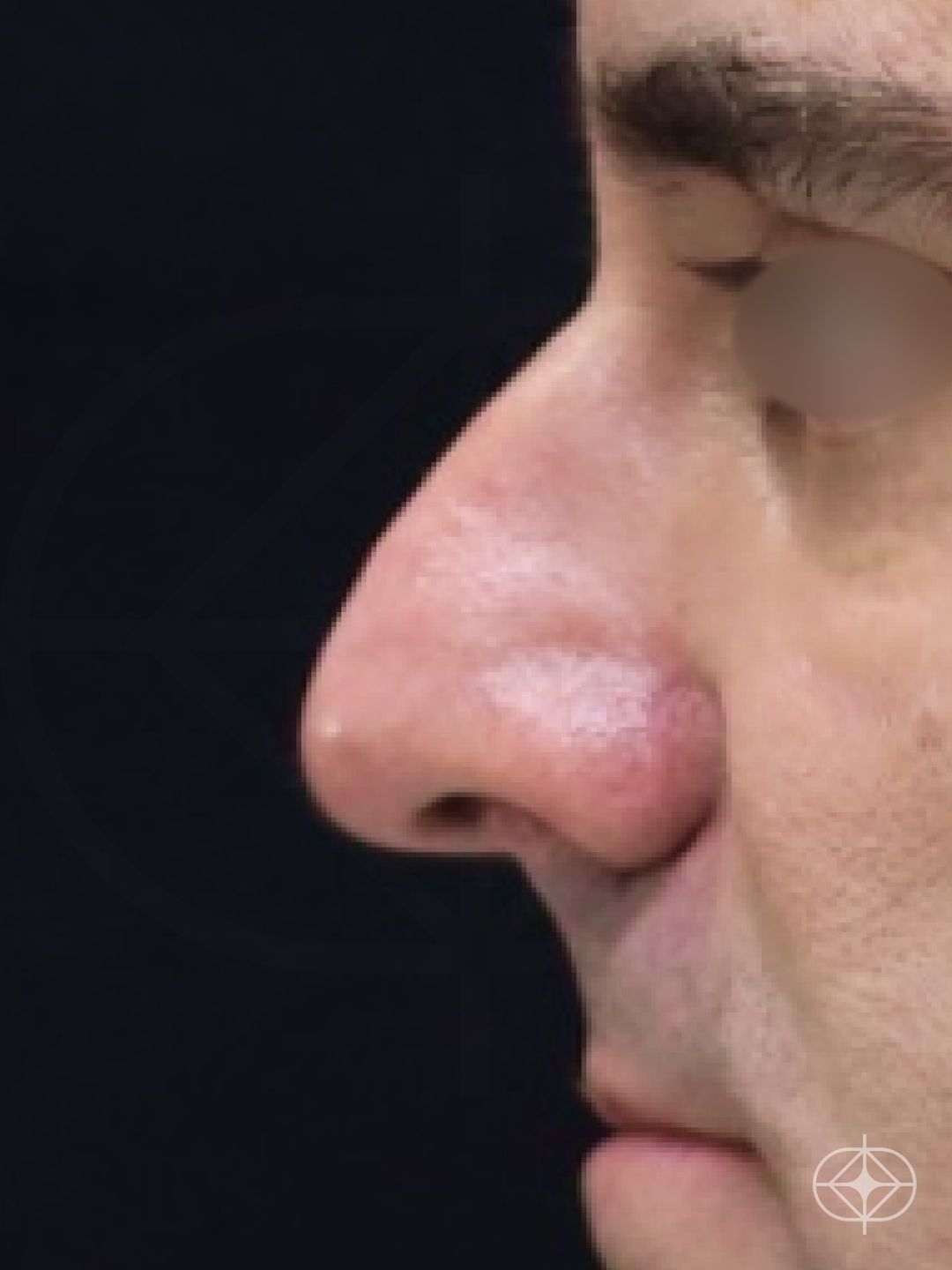 Foto antes de Rinoplastia (nariz) realizado por Dr. Eduardo Zomer