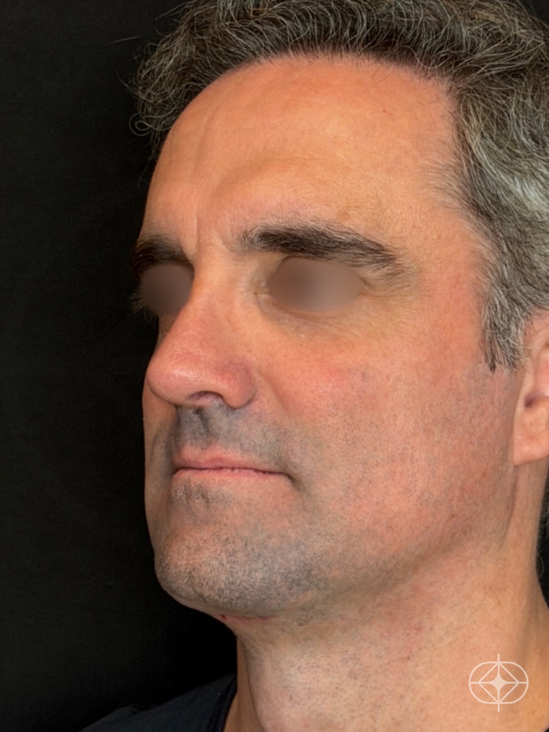 Resultado após Rinoplastia (nariz) realizado por Dr. Eduardo Zomer
