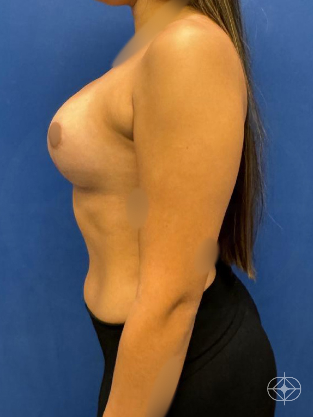 Resultado após Mastopexia com Prótese (silicone) realizado por Dr. Thiago Cavalcanti