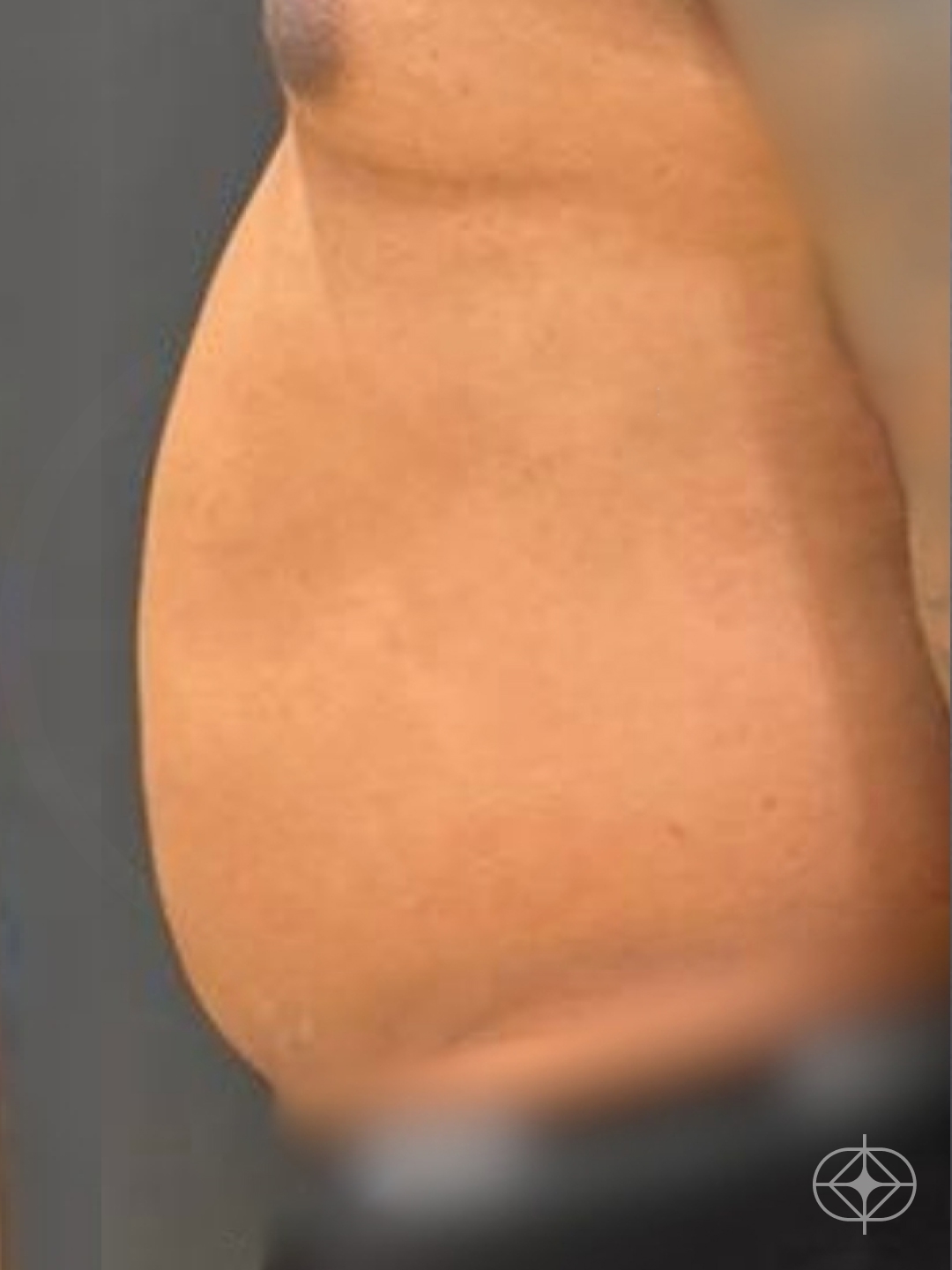 Foto antes de Lipoaspiração / Lipo HD realizado por Dr. Luis Fernando Bacarin
