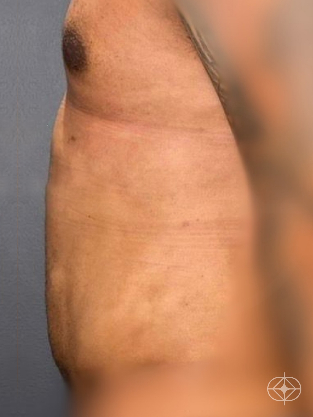 Resultado após Lipoaspiração / Lipo HD realizado por Dr. Luis Fernando Bacarin
