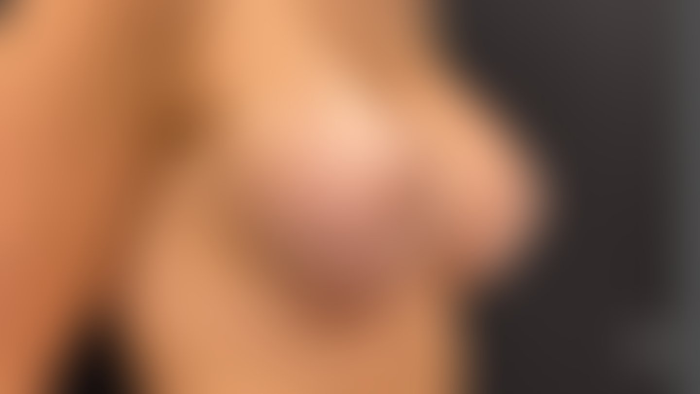 Resultado após Preservé Prótese de Mama (silicone) realizado por Dr. Eduardo Fraga
