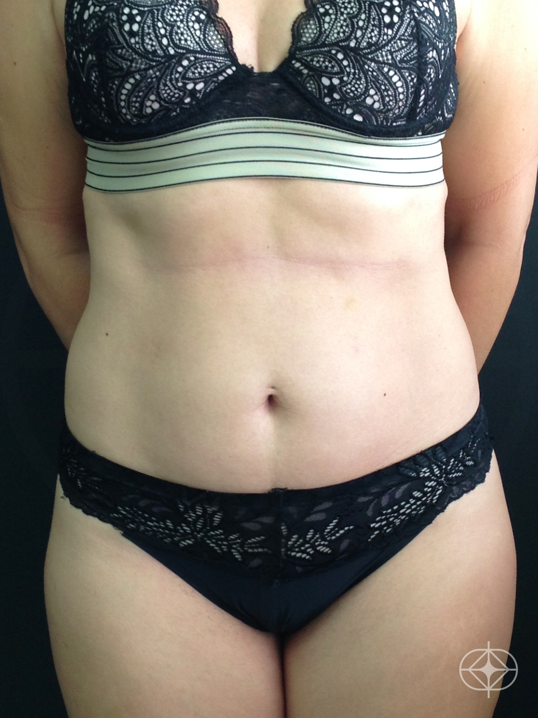 Foto antes de Lipoaspiração / Lipo HD realizado por Dr. Thiago Tubone
