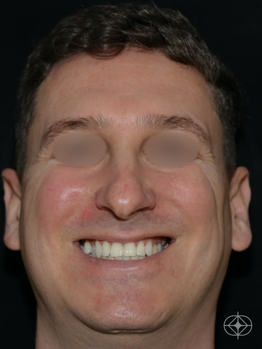 Foto antes de Rinoplastia (nariz) realizado por Dr. Eduardo Zomer