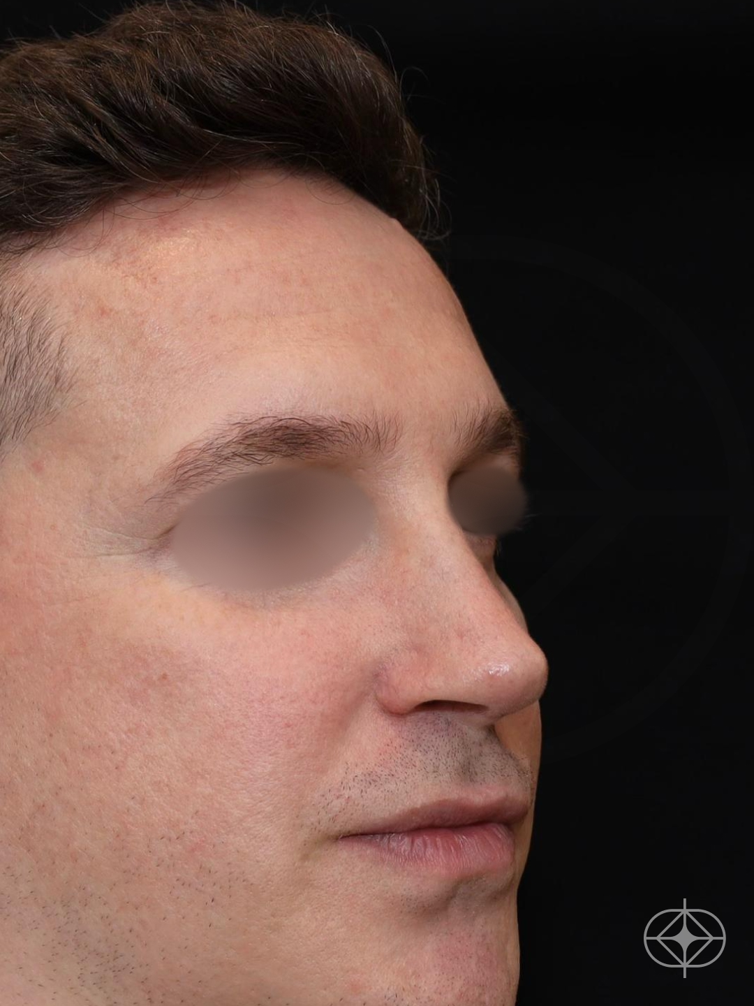 Rinoplastia (nariz) - Pós