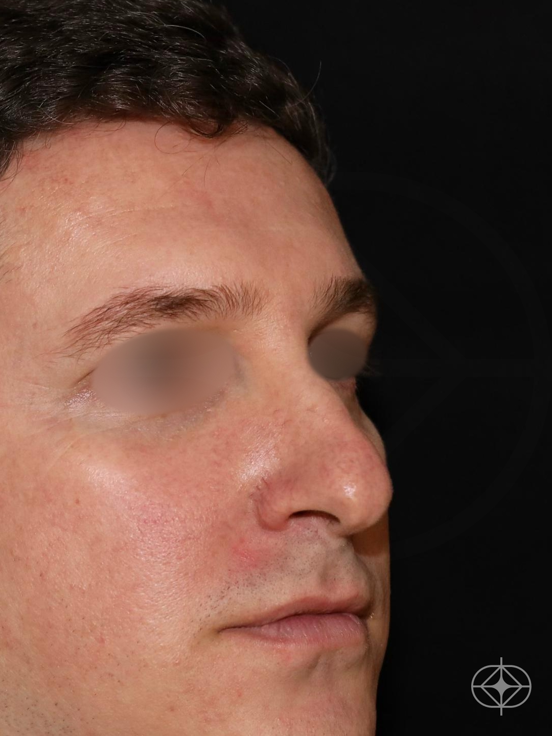 Rinoplastia (nariz) - Pré