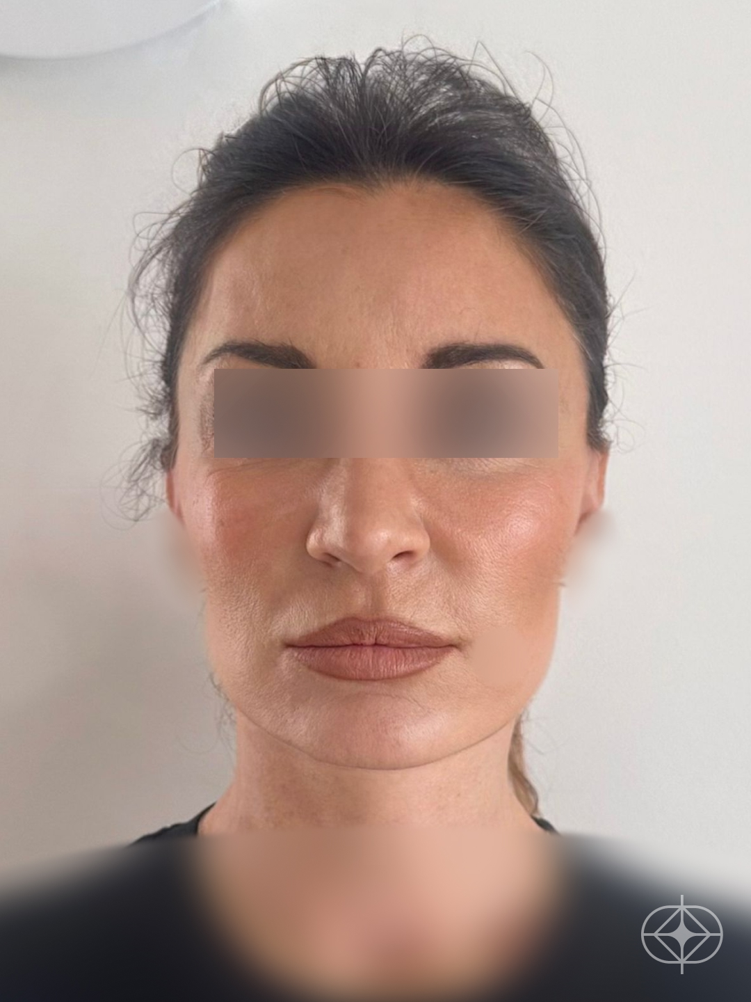 Facelift Deep Plane - Pós