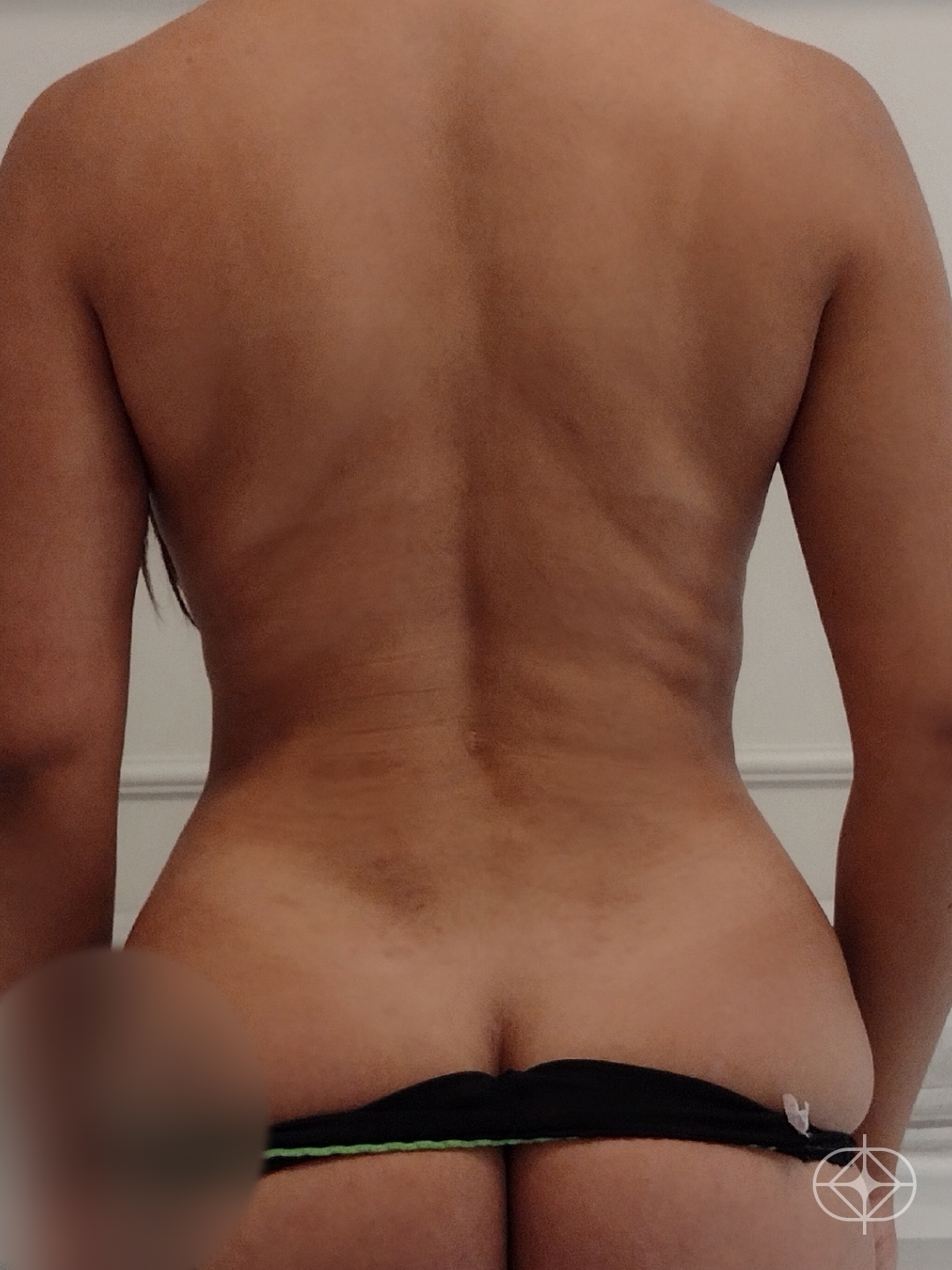 Lipoaspiração / Lipo HD - Pós